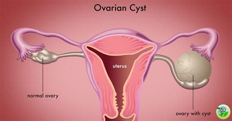 Removal of Ovarian Cysts by the administration of a Single Remedy, Thuja occidentals: Hormonal ...