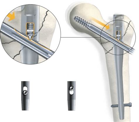 Locking the lag screw is achieved by tightening the set screw and... | Download Scientific Diagram