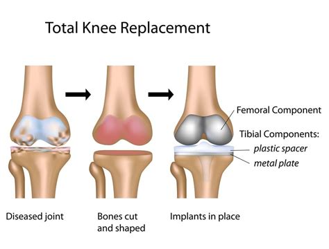 Total Knee Replacement – Pacific Bone & Joint Clinic