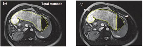 MRI image slices of the stomach highlighting the (a) total stomach (b)... | Download Scientific ...