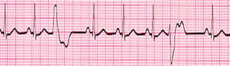 pvc-multifocal - Cardiac Sciences Manitoba