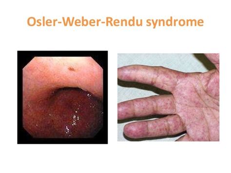 Neurocutaneous disorders