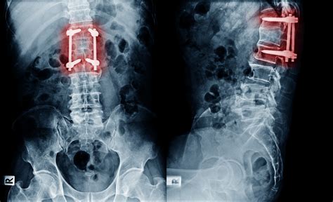 FUSION VERTÉBRALE : Vers de nouveaux implants intelligents | santé log