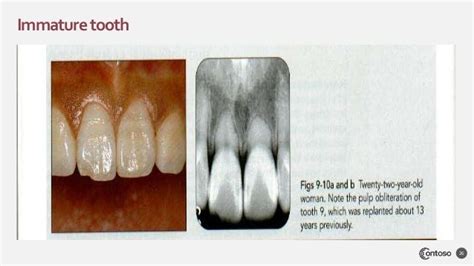 Tooth avulsion dr.maryam salman