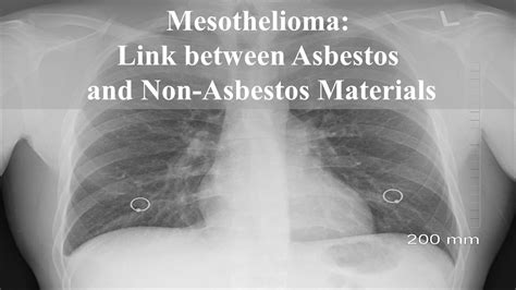 Mesothelioma: Link between Asbestos and Non-Asbestos Materials - Yo Nature