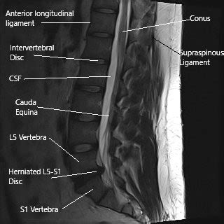 Surgical Treatment of Sciatica of Lumbar Radiculopathy | Complete Orthopedics | Multiple NY ...