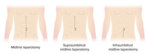 Laparotomy and Laparoscopy | Concise Medical Knowledge