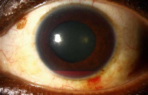 Hyphema causes, symptoms, grading, complications, recovery & treatment