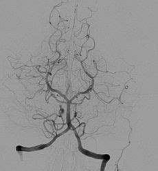 Angiography - Wikipedia, the free encyclopedia