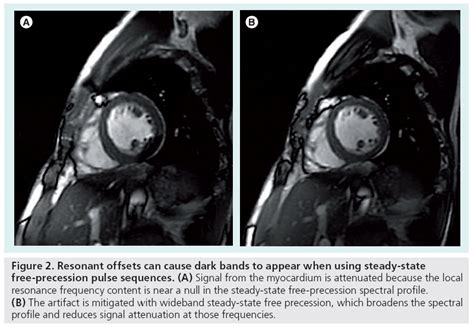 MRI artifacts and correction strategies