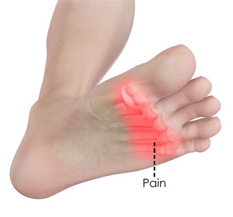 Forefoot Pain Treatment Springfield | Metatarsalgia Chicopee, East Longmeadow