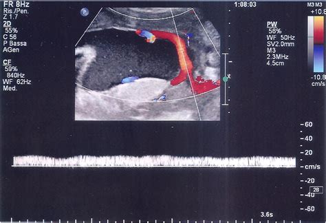 Figure 4 from Succenturiate lobe of placenta with vessel anomaly: a case report of prenatal ...