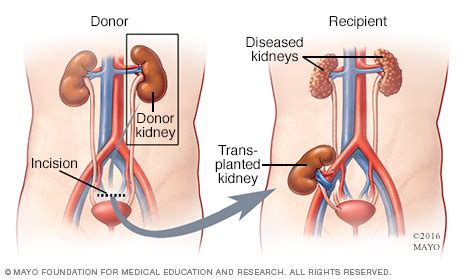 SURGSEMINAR: Renal Transplantation 3