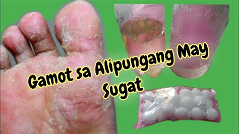 Gamot sa Alipungang May Sugat, Mabilis Gumaling at Matuyo (Athlete's Foot Home Remedy) - YouTube