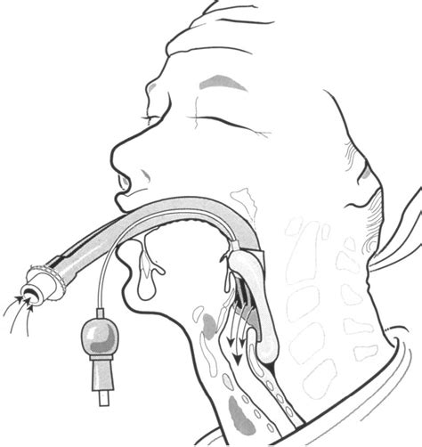 Figure 1 from Using the laryngeal mask airway to manage the difficult ...