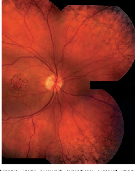 Figure 1 from Peripheral retinal drusen and reticular pigment ...