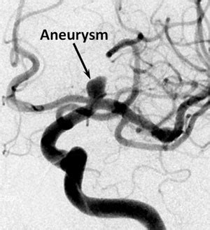 Brain Aneurysm | Radiology