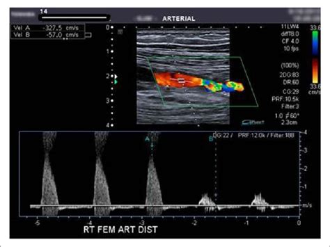 Example of an ultrasound Duplex scan image. | Download Scientific Diagram