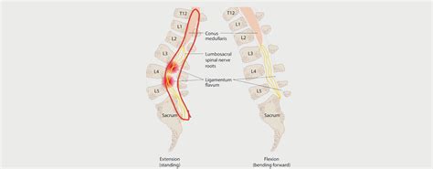 LUMBAR RADICULOPATHY - MOTUS Physical Therapy