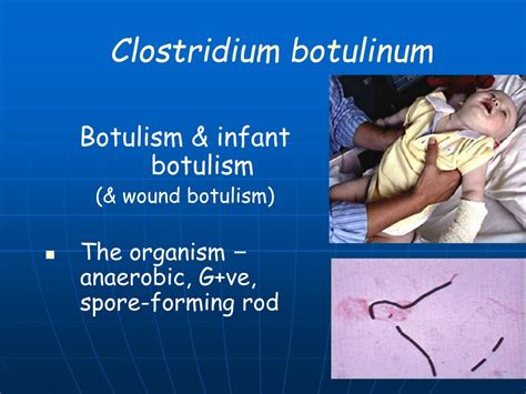 Botulism Symptoms