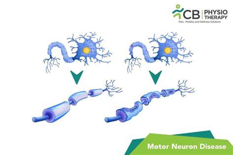 What Is Motor Neuron Disease (MND)?, Symptoms, Causes, Diagnosis & Physiotherapy Treatment Of ...