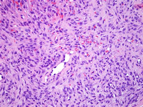 Benign Fibrous Histiocytoma | Dermatopathology