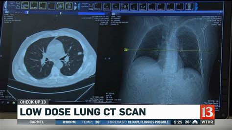 Check Up 13: Low dose lung CT scan - YouTube