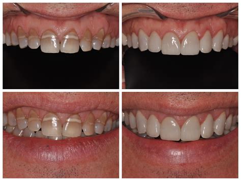 Smile Spotlight: David | Transform Tetracycline Stains on Teeth