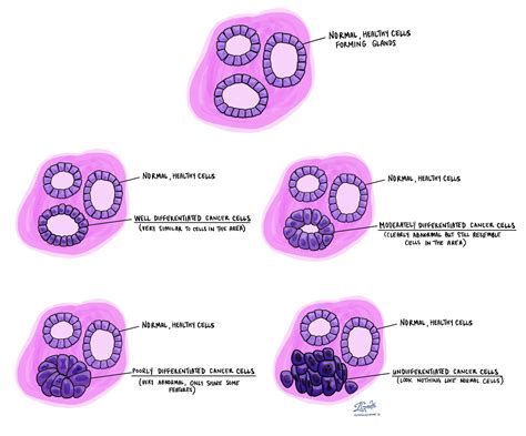 Differentiated - MyPathologyReport.ca