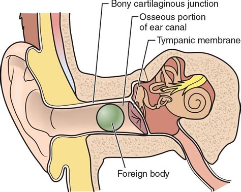 Ear Foreign Body Removal | Anesthesia Key