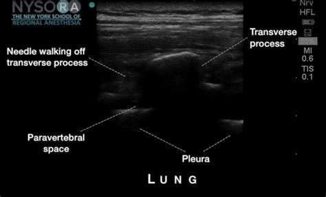 Paravertebral Nerve Block Ultrasound