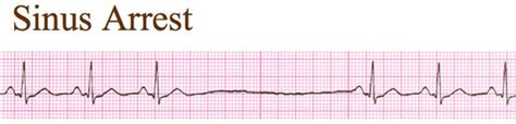 SA Block and Sinus Arrest