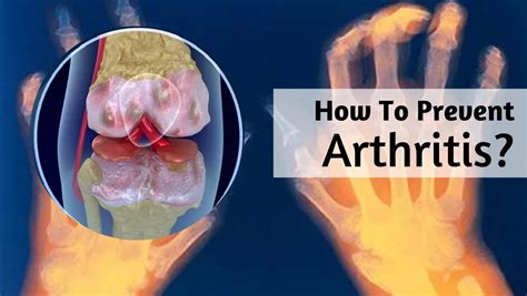 How To Prevent Arthritis: 10 Things You Can Do To Keep Your Bones ...