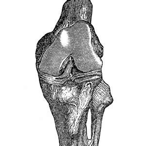 Illustration showing torn human knee ligament available as Framed Prints, Photos, Wall Art and ...