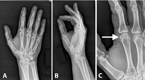 Sesamoid Bone Fracture