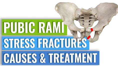 Pubic Ramus Stress Fractures Treatment - YouTube