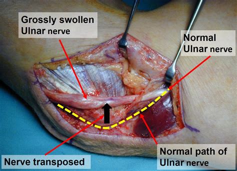 Cubital Tunnel Syndrome