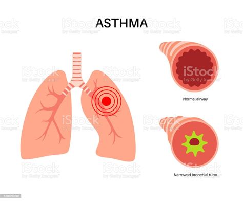 Asthma Lung Disease Stock Illustration - Download Image Now - Allergy ...