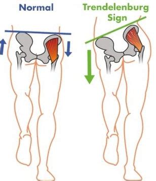 Gluteal Tendinopathy |Sydney CBD Physiotherapy