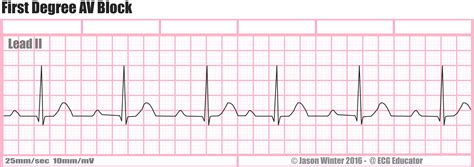 ECG Educator Blog : First Degree AV Bock