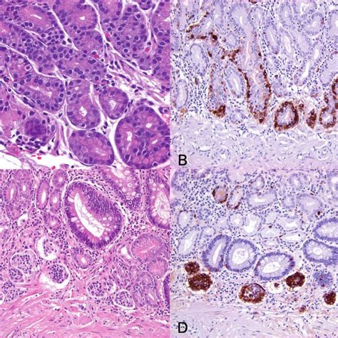 A, Gastrin immunohistochemical stain highlighting G cells in normal ...