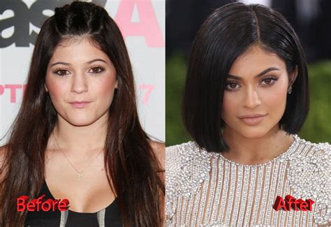 Kylie Jenner Plastic Surgery Facts, Rumors and News