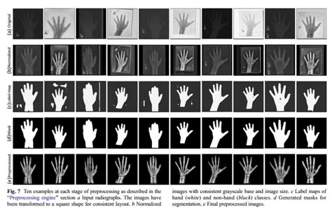 Fully Automated Deep Learning System for Bone Age Assessment - Lab of ...