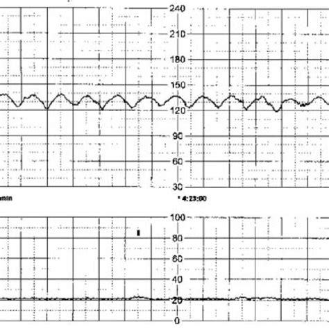 (PDF) Sinusoidal fetal heart rate pattern: Its definition and clinical significance