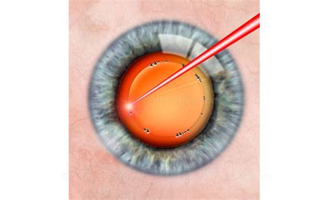 Laser cataract surgery capsulorhexis #SUCA0070 - Stock eye images