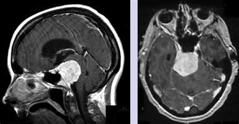 Management of Petroclival Meningiomas: Subtotal Resection and Radiosurgery vs. Total Removal ...