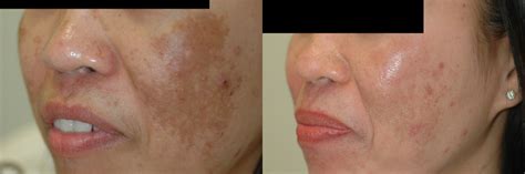 melasma-before-after