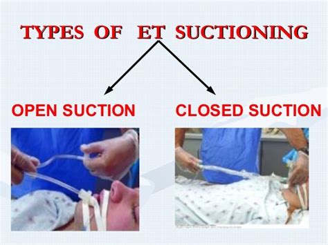 Endo tracheal Suctioning