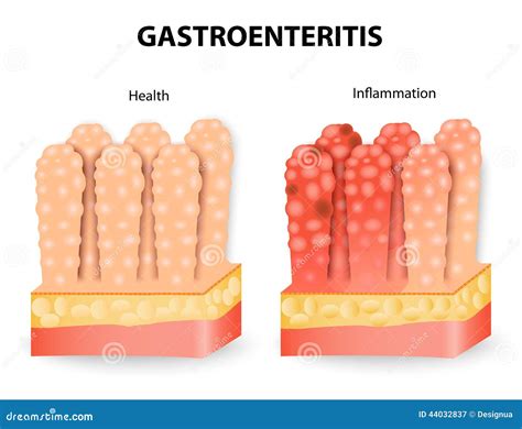 Gastroenteritis Or Infectious Diarrhea Stock Vector - Image: 44032837