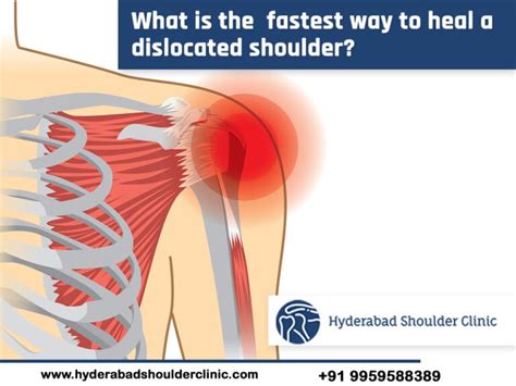 Do you know What Is The Fastest Way To Heal A Dislocated Shoulder ...